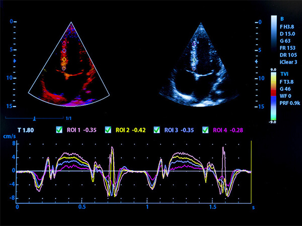 cardiac ultrasound imaging